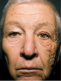 Old man looking at camera with lots of wrinkles on one side of his face