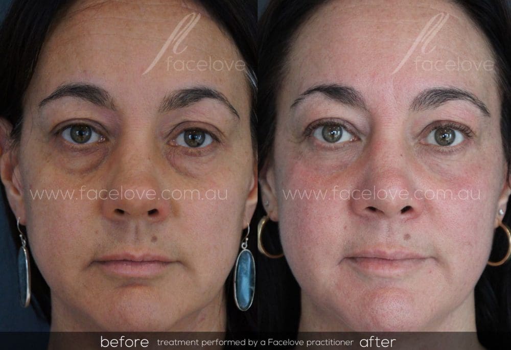 Secret RF Skin Micro Needling Treatment Facelove