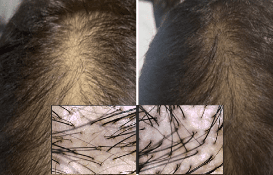 Exosomes for hair growth female baldness facelove