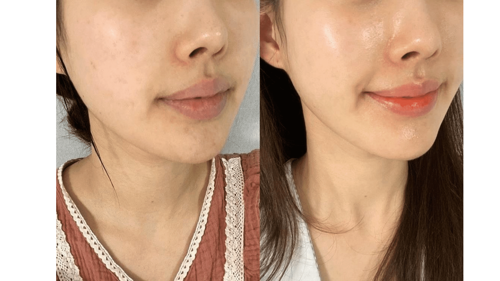 exosomes exomide xytide stem cells pigment clear skin