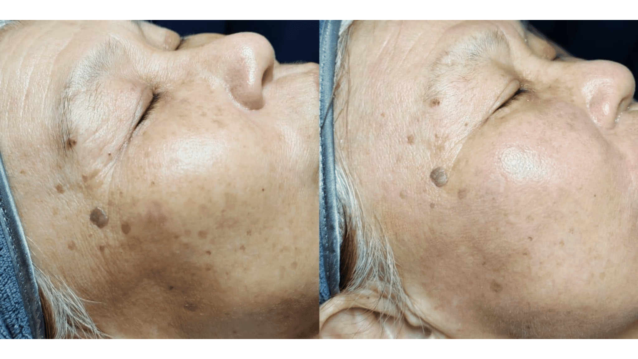 exosomes exomide xytide stem cells pigment